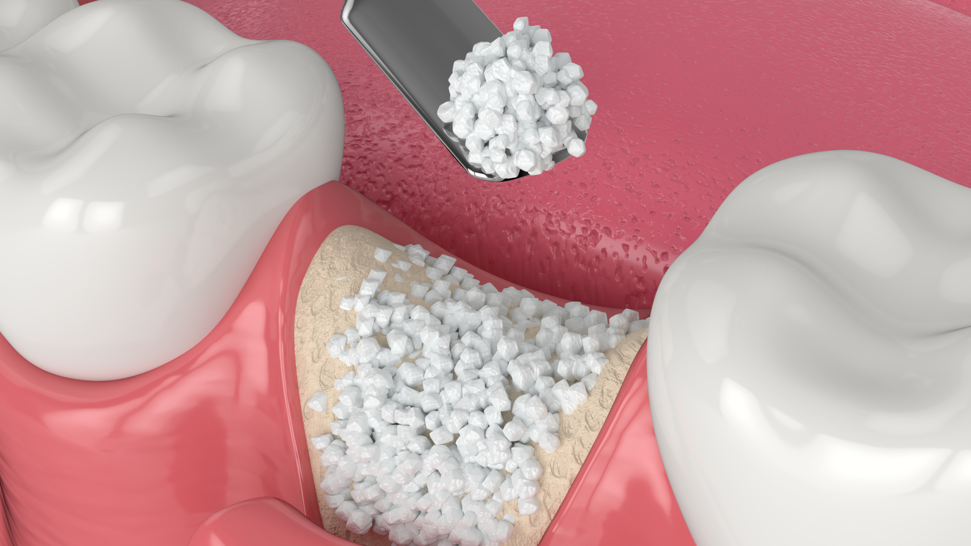 Bone Grafting treatment at Dr. Varshney's Dental Aesthetics in Nani Daman