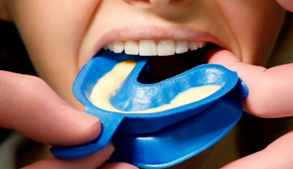 Fluoride Application treatment at Dr. Varshney's Dental Aesthetics in Nani Daman