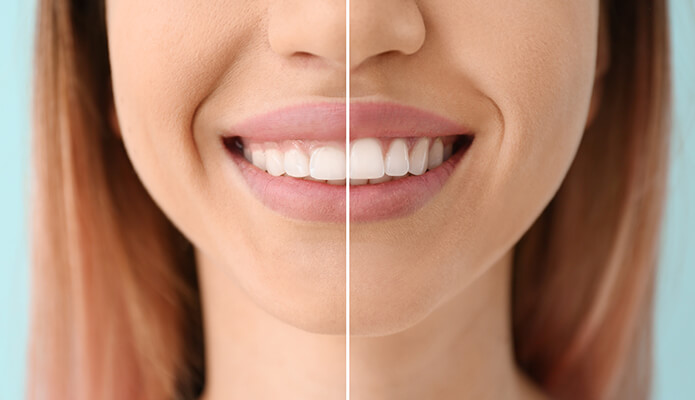 Gingivoplasty treatment at Dr. Varshney's Dental Aesthetics in Nani Daman