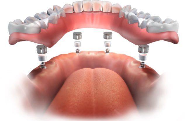 Implant-Supported Dentures treatment at Dr. Varshney's Dental Aesthetics in Nani Daman