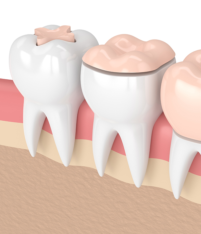 Inlay and Onlays treatment at Dr. Varshney's Dental Aesthetics in Nani Daman