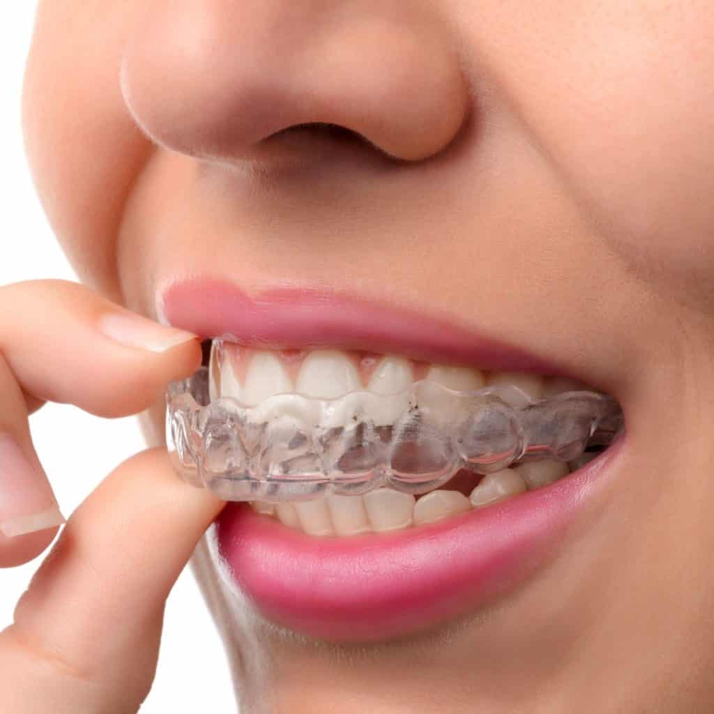 Night Guards for Teeth Grinding treatment at Dr. Varshney's Dental Aesthetics in Nani Daman