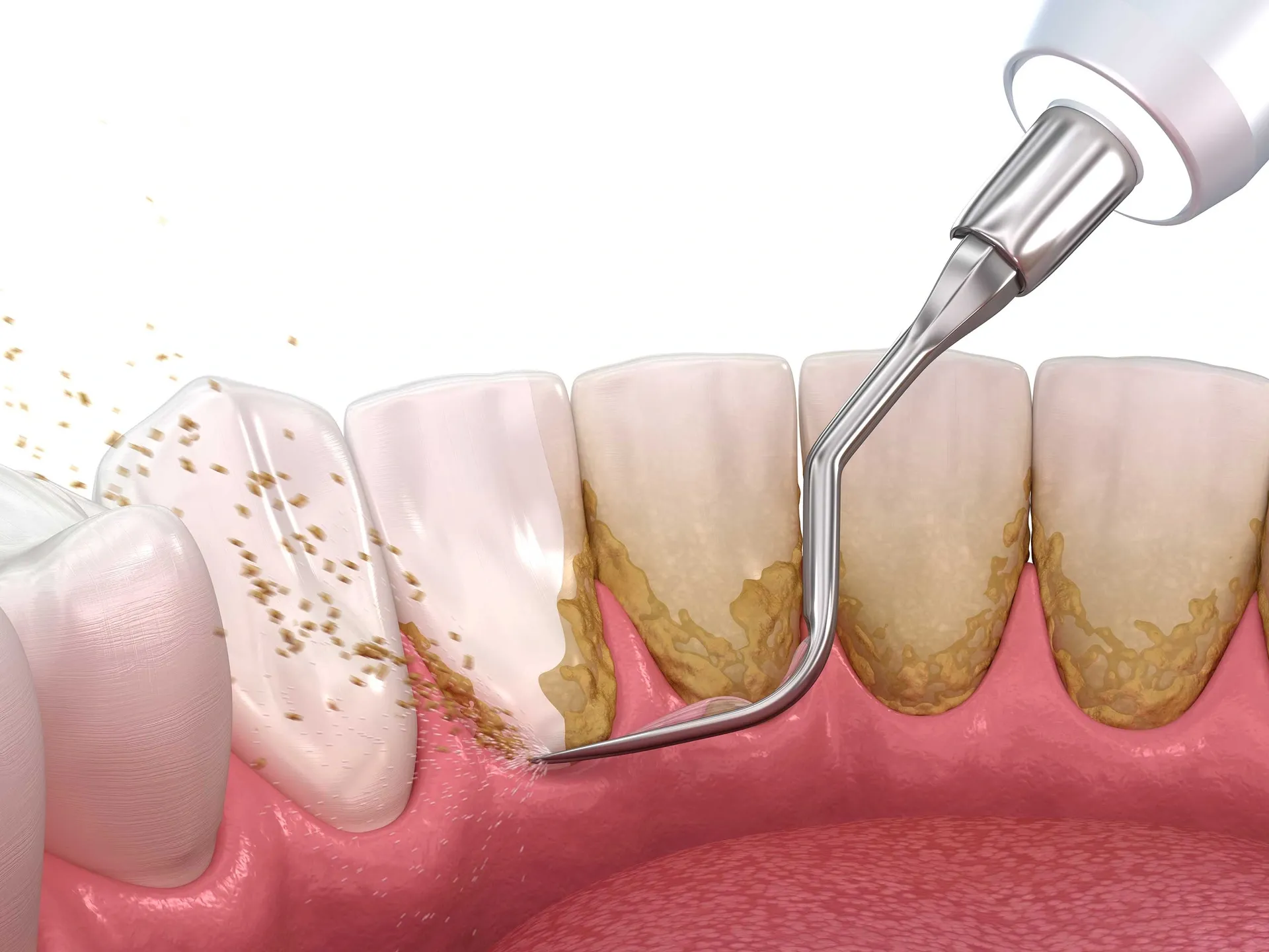 Scaling treatment at Dr. Varshney's Dental Aesthetics in Nani Daman