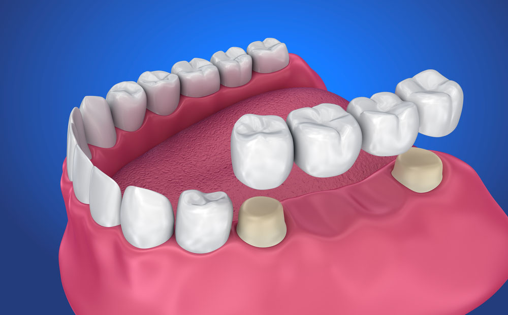 Crowns & Bridges, Dentures treatment at Dr. Varshney's Dental Aesthetics in Nani Daman