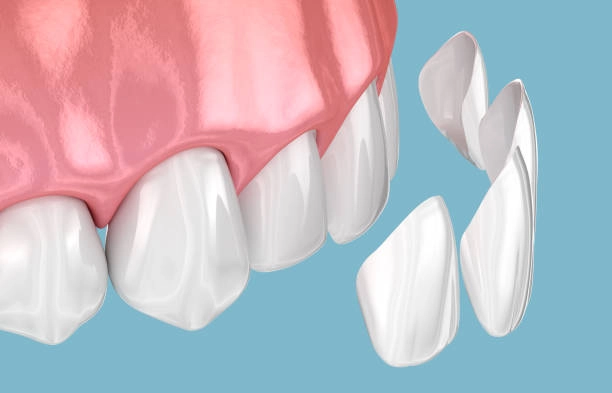 Dental Veneers treatment at Dr. Varshney's Dental Aesthetics in Nani Daman