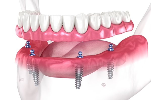 Implants treatment at Dr. Varshney's Dental Aesthetics in Nani Daman
