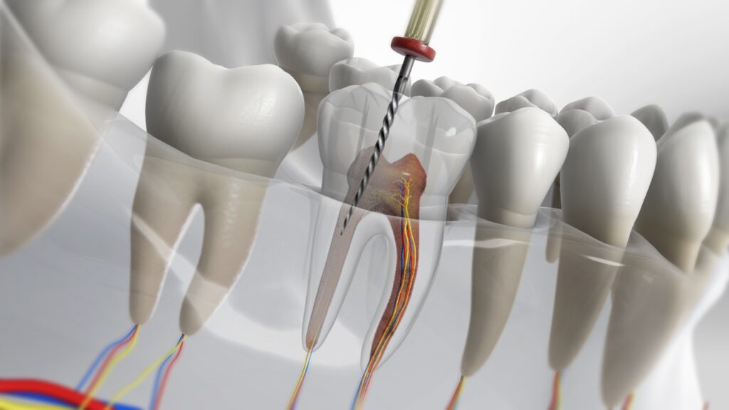 Post and Core Treatment treatment at Dr. Varshney's Dental Aesthetics in Nani Daman