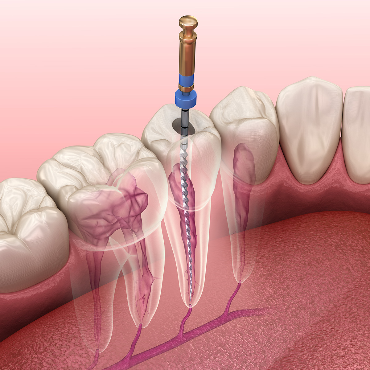 Root Canal Treatment treatment at Dr. Varshney's Dental Aesthetics in Nani Daman