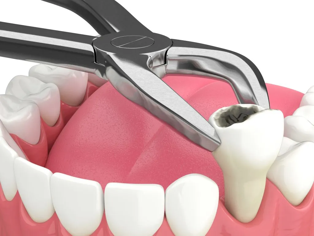Tooth Extraction treatment at Dr. Varshney's Dental Aesthetics in Nani Daman