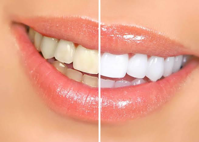 Teeth Whitening treatment at Dr. Varshney's Dental Aesthetics in Nani Daman