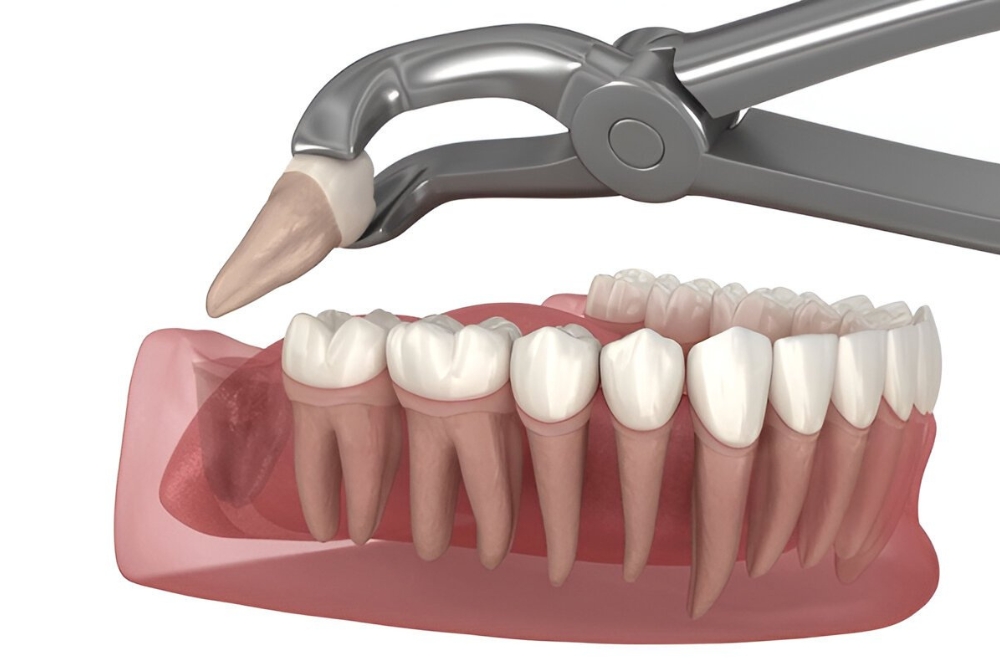 Wisdom Tooth Removal treatment at Dr. Varshney's Dental Aesthetics in Nani Daman
